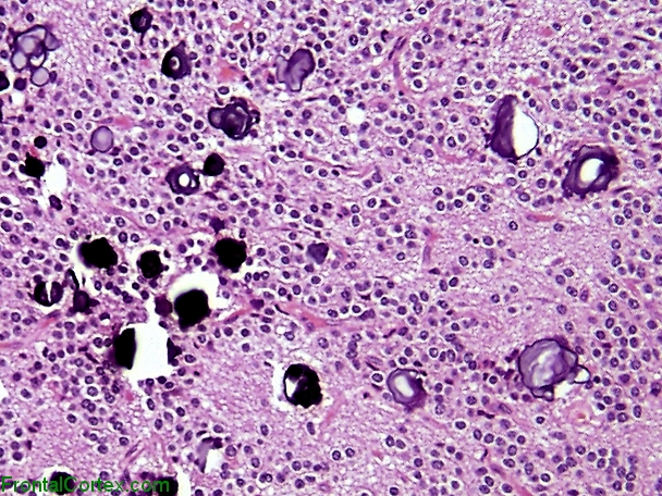 Central Neurocytoma