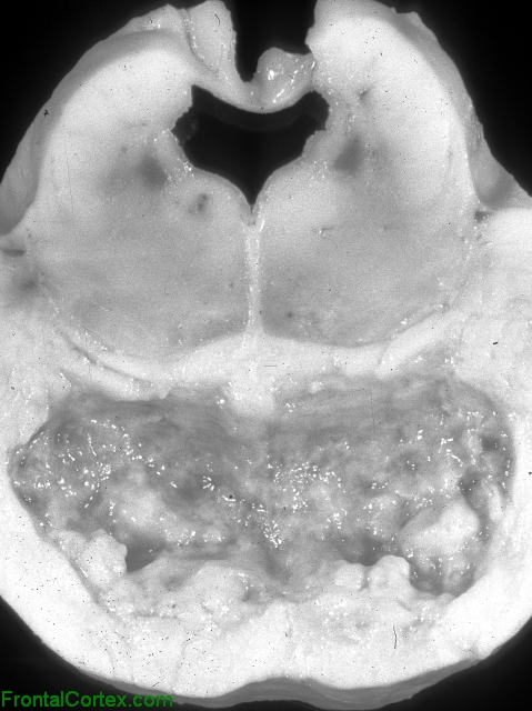 Central Pontine Myelinolysis, transverse section