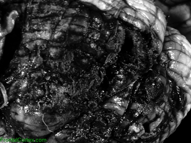 Hemagioblastoma,dorsal surface of cerebellum