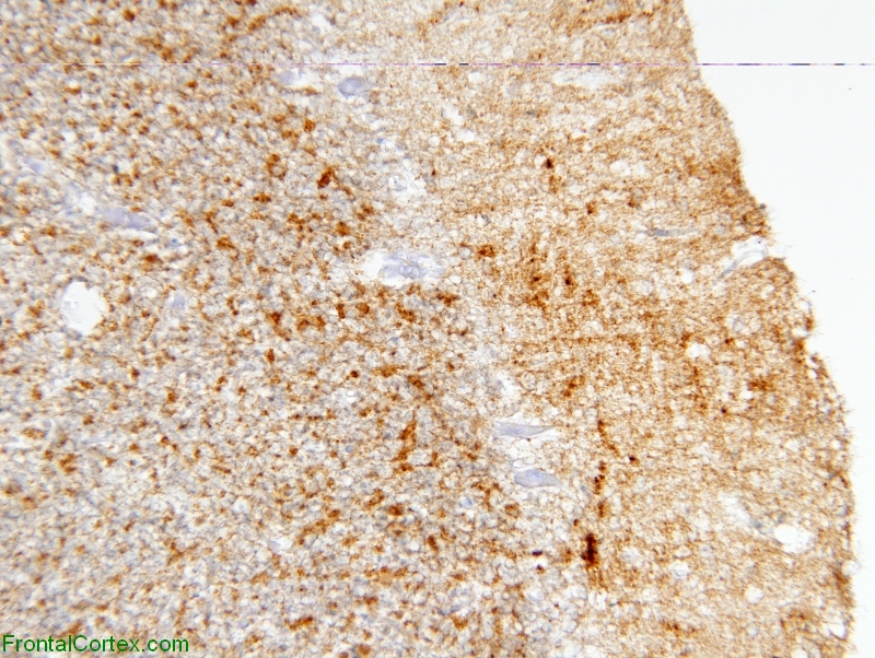 Sporadic JCD in cerebellum, immune stain