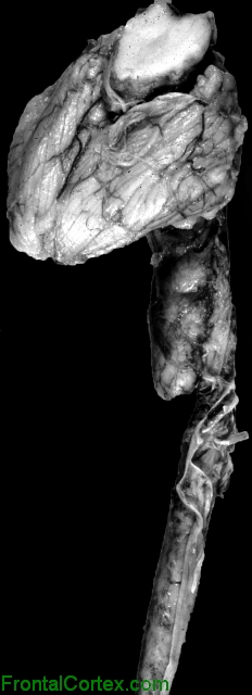 Chiari II malformation, spinal cord and posterior fossa structures