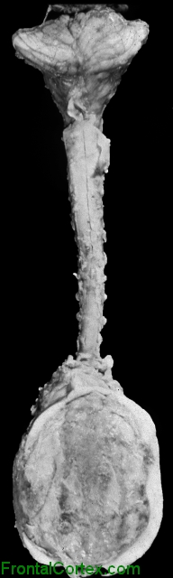 Chiari II malformation, complete dorsal view of dissected spinal cord and posterior fossa