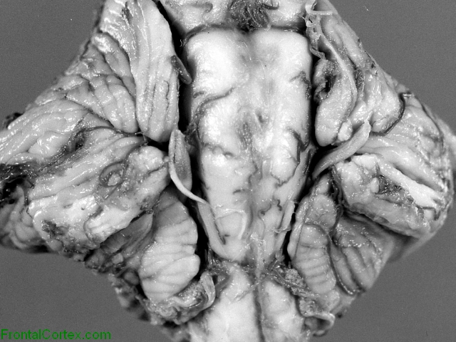 Chiari II malformation, ventral surface of posterior fossa structures