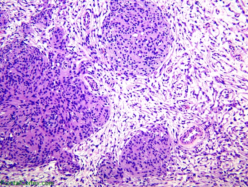 Chordoid Meningioma