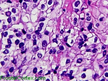 Clear Cell Ependymoma, high power H&E stained section