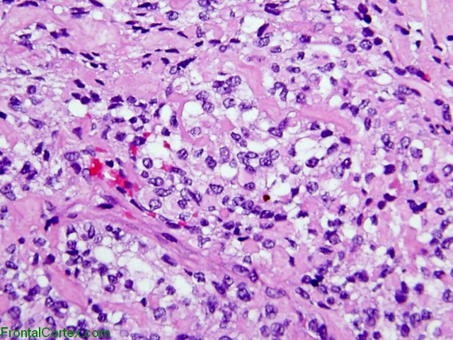 Clear Cell Menigioma, H&E