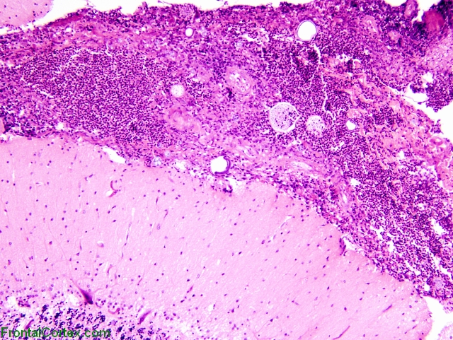 Acute meningitis secondary to Coccidioides, cerebellum, low power H&E stain.