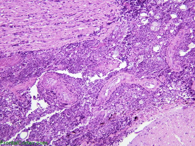 Cranial nerve inflammation secondary to coccidial meningitis, H&E stained section