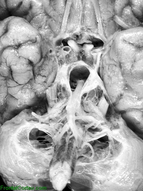 Cockayne syndrome, ventral surface of brain