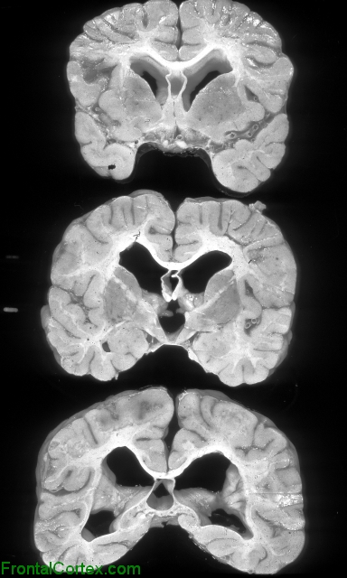 Cockayne syndrome, multiple coronal sections of brain