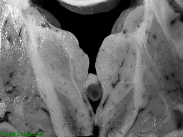 Collid Cyst, coronal section through third ventricle.