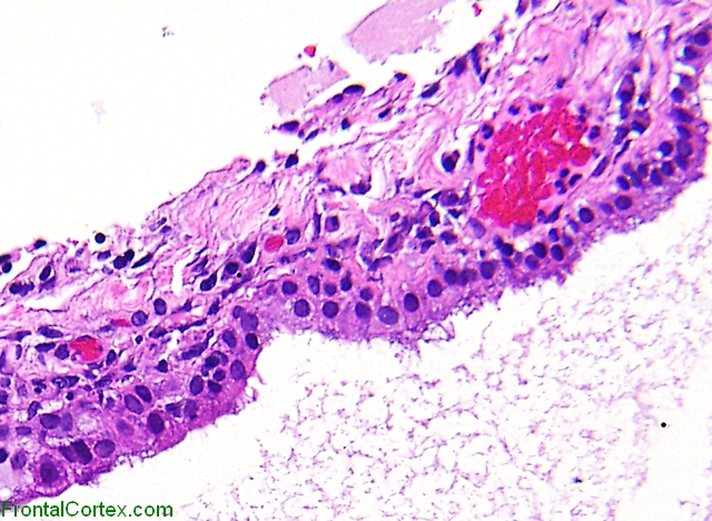 Colloid Cyst, H&E stained section