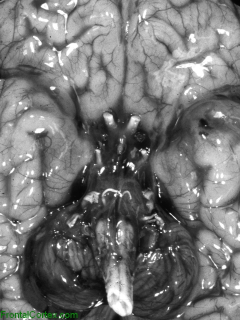 Congenital neurosyphilis, ventral surface of brain.