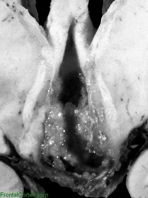 Craniopharyngioma, coronal section through hypothalamus