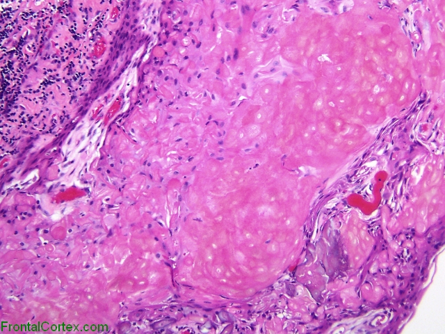 Craniopharyngioma, medium power H&E stained slide demonstrating "wet keratin".