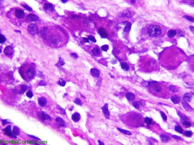 Crooke Hyaline Change Pituitary Adenoma