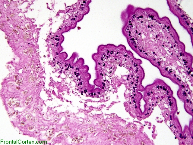 Cysticercosis H&E Low Power