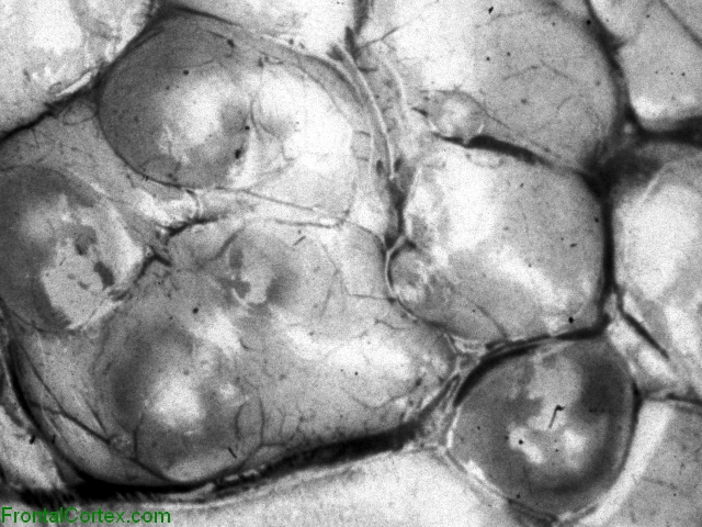 Cysticercosis, surface of cerebral cortex, close-up