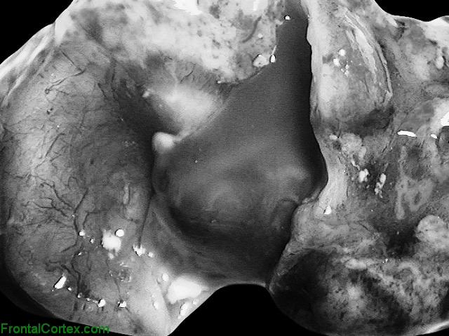 Cysticercosis Surgical