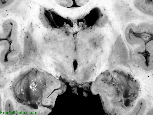 Cytomegalovirus infection in AIDS, coronal section through thalamic nuclei.