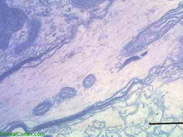 Axon entering demyelinative plaque, ultrastructural section