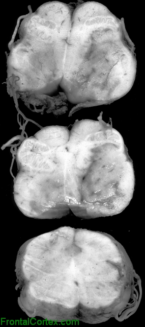 Dorsolateral Medullary infarct, multiple transverse sections through medulla