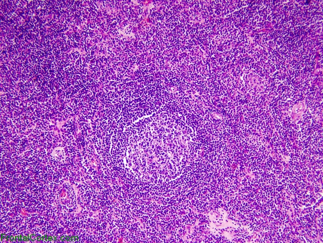 Dura Malt Lymphoma x100