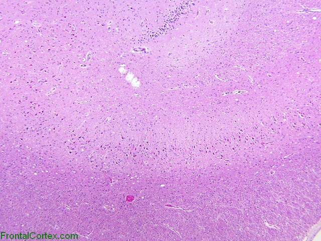 Eosinophilic Neuronal Degeneration, Hippocampus, H&E x40