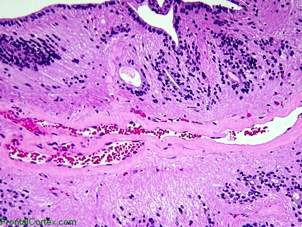 Ependymal Pseudorosette, H&E stained section.