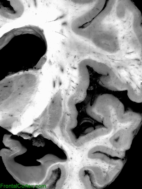 Frontotemporal lobar degeneration, coronal section through temporal lobe.