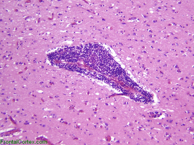 Primary angiitis of the central nervous system, low power H&E stained section