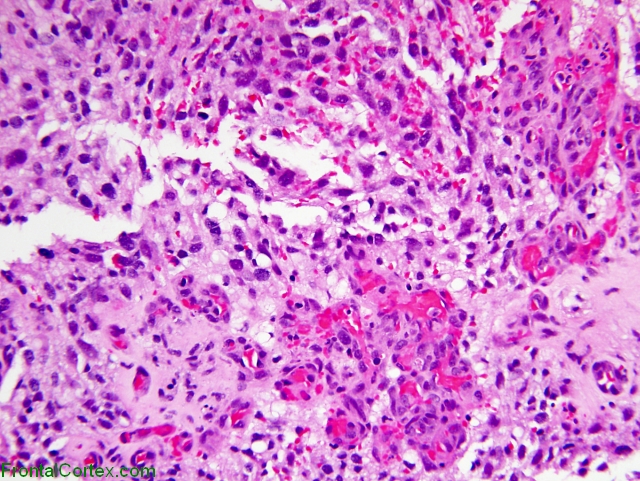 Glioblastoma multiforme presenting as extramedullary spinal tumor