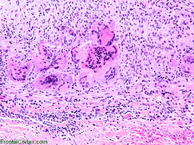 Giant cell arteritis involving temporal artery, high power H&E stained slide