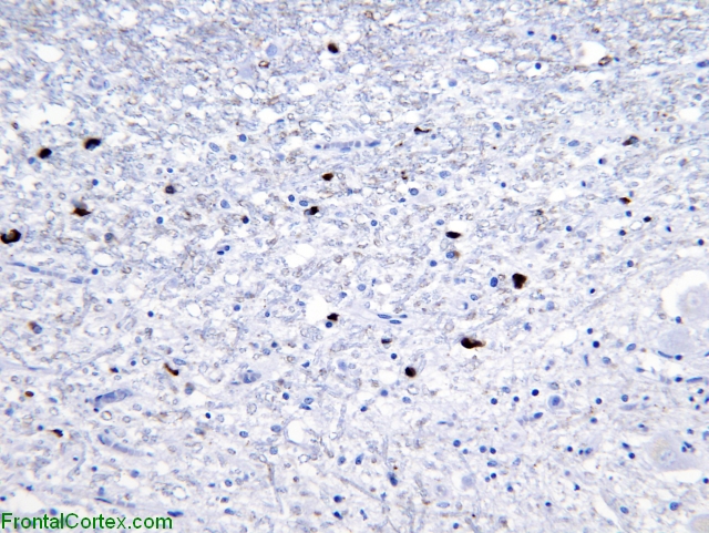 Multiple system atrophy, alpha synuclein immunohistochemical staining within dentate nucleus of cerebellum.