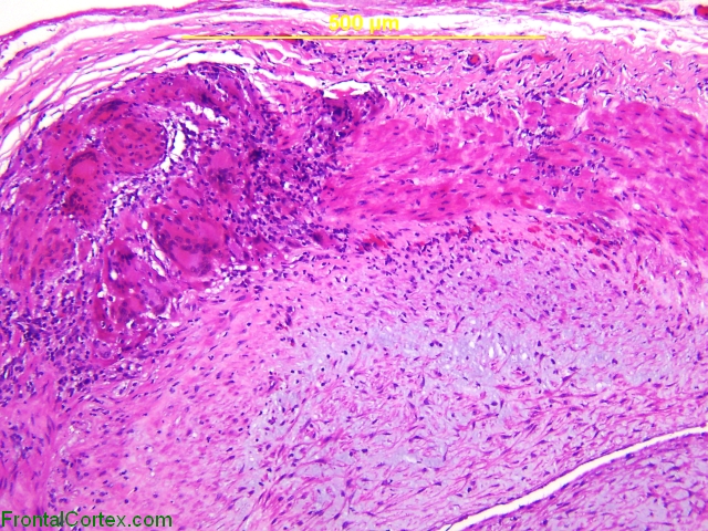 Giant Cell Arteritis, H&E stained x 100