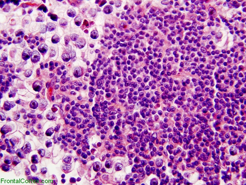 Germinoma, H&E stain x 400