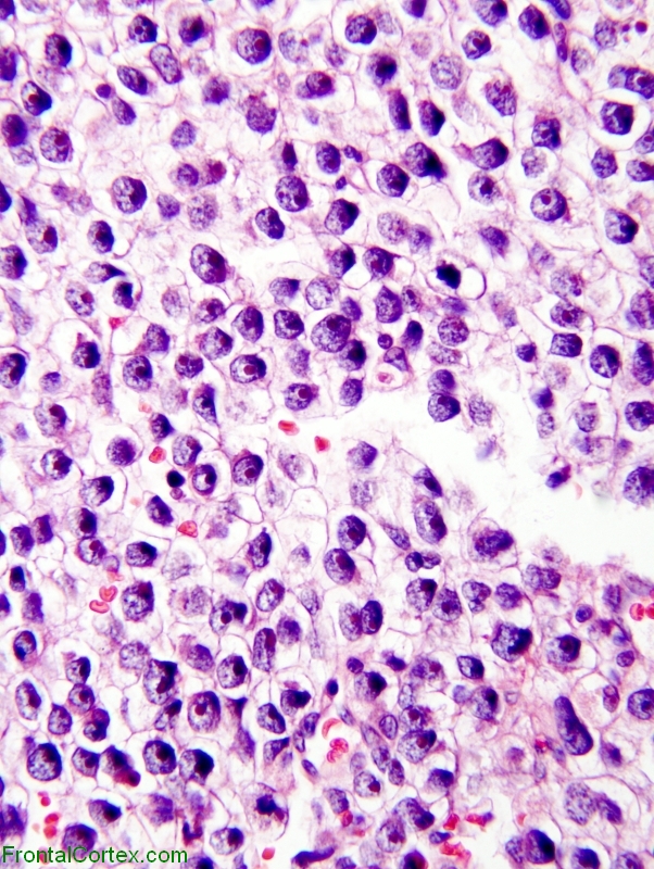 Germinoma, H&E stain x 400