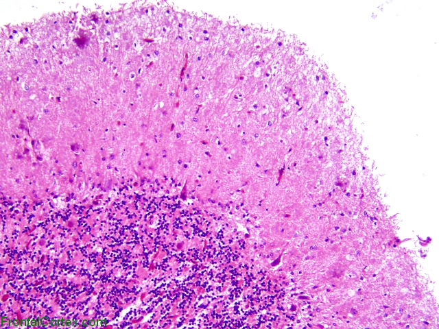 Gerstmann Straussler Scheinker disease, cerebellum, H&E stained section, low-power