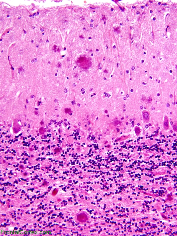 Gerstmann Straussler Scheinker disease,  cerebellar cortex, H&E stain x 200