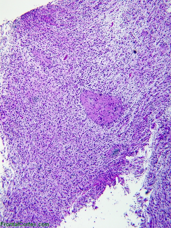 Glioneuronal Tumor with Neuropil Islands, H&E stain x 40