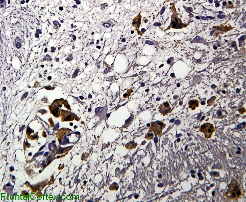 HIV encephalopathy, p24 immunohistochemical staining for HIV