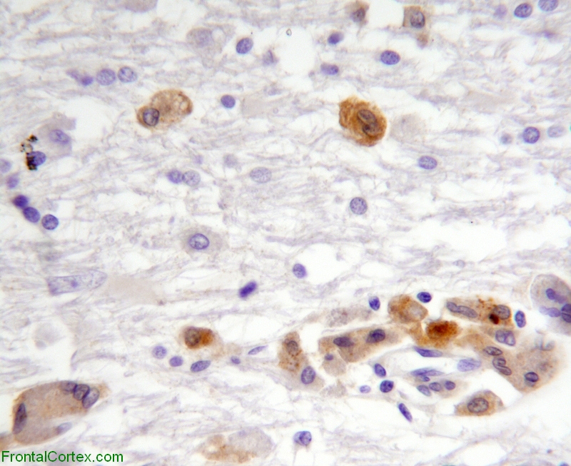 HIV encephalopathy, P24 immunohistochemical staining for HIV x 400