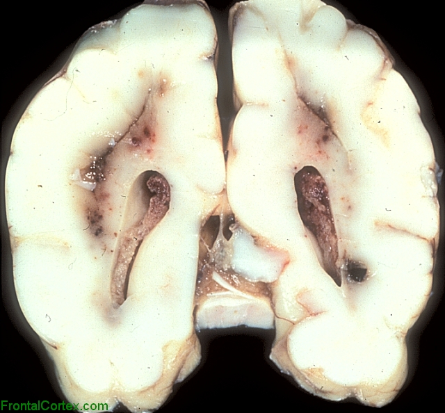 Periventricular leukomalacia with hemorrhagic transformation.