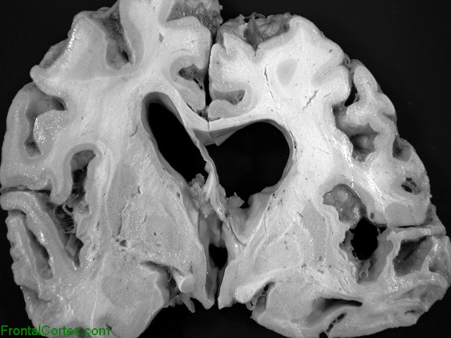 Hereditary dysphasic dementia, coronal section of brain.