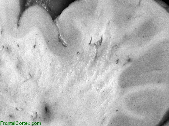 Hereditary diffuse leukoencephalopathy with spheroids, coronal section through brain, close-up