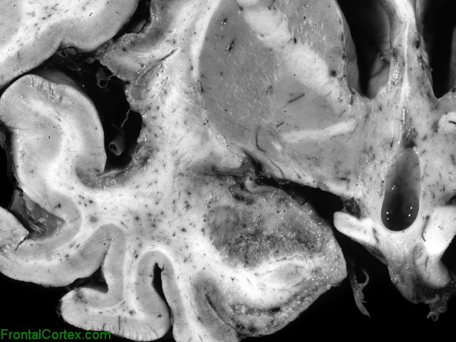 Herpes simplex encephalitis, coronal section through temporal lobe and basal ganglia.