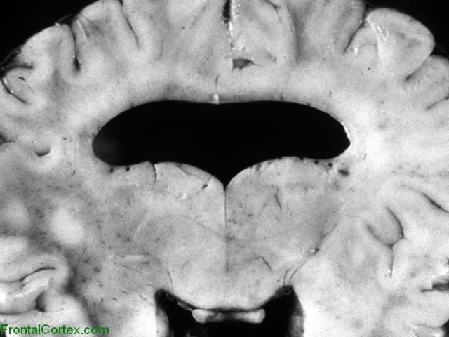 Alobar holoprosencephaly,   Coronal section through brain