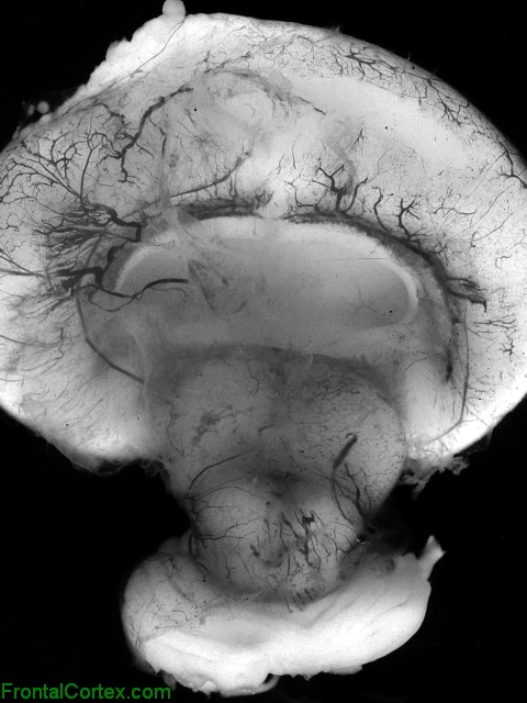 Holoprosencephaly, dorsal view of autopsy brain