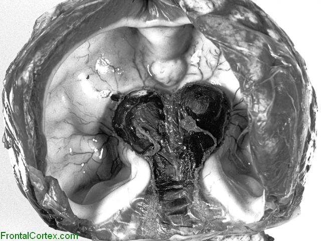 Holoprosencephaly, in situ photograph, coronal section through skull