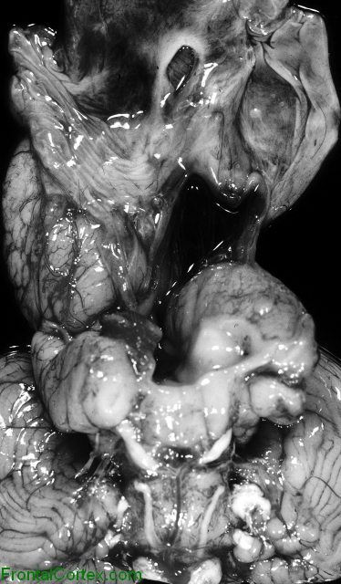 Hydranencephaly, ventral surface of brain.